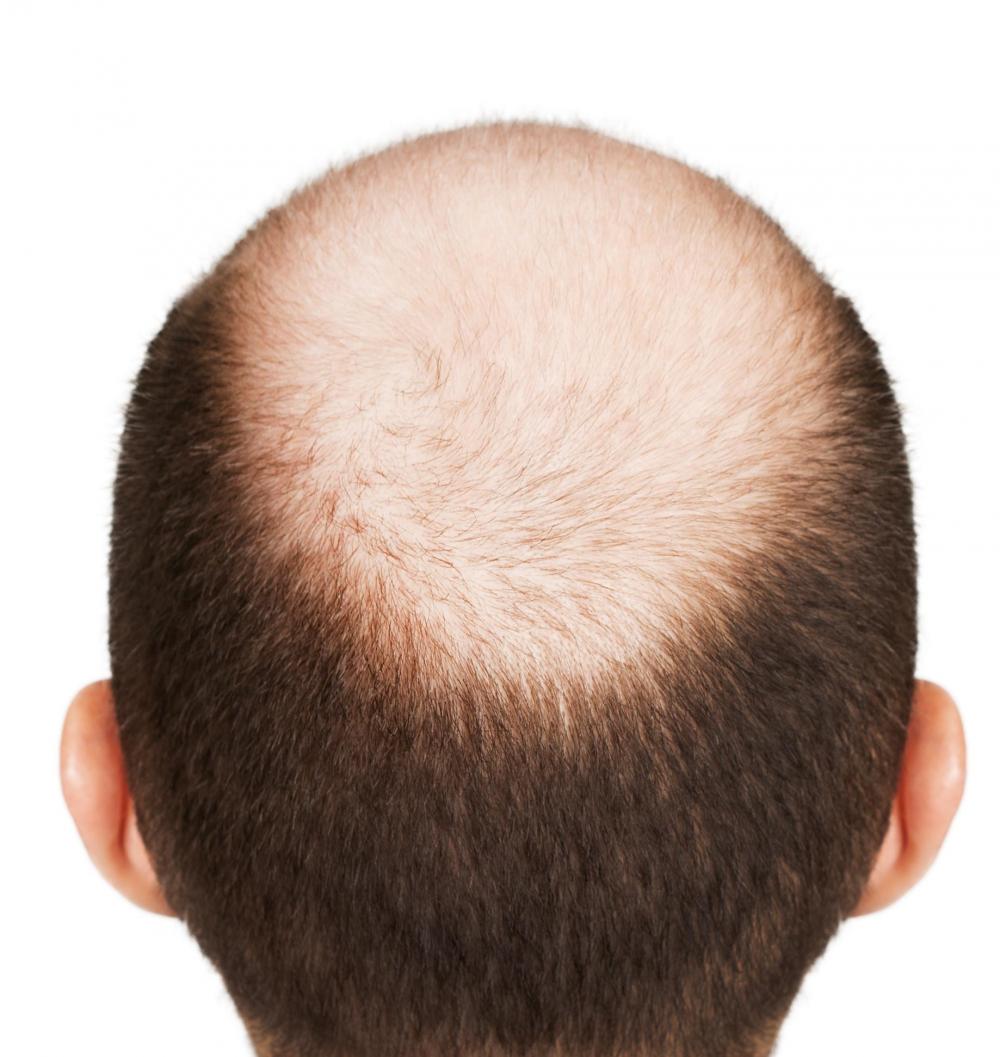 Pattern hair loss - Wikipedia
