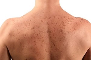 Steroids acne on arms